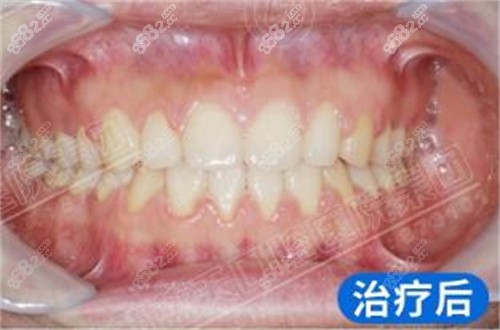 藍(lán)天口腔矯正后
