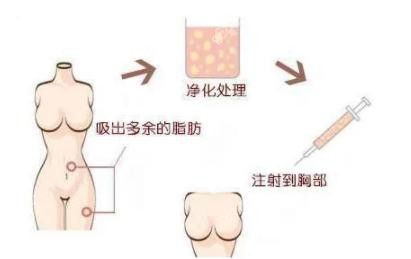 北京东方和谐脂肪隆胸过程图