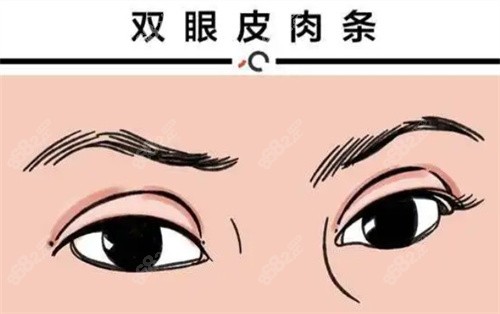 雙眼皮肉條示意圖