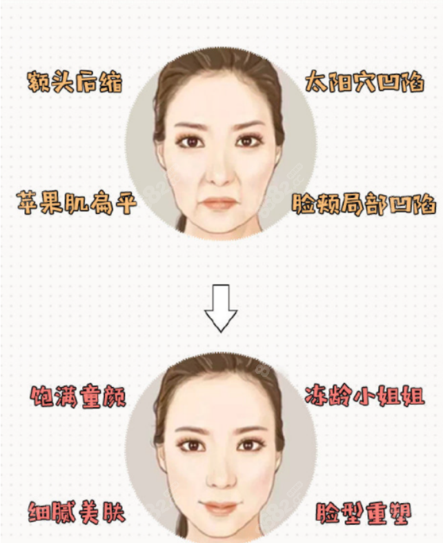 王自谦医生做面部脂肪填充手术