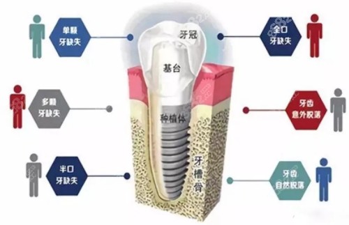 种植牙图解