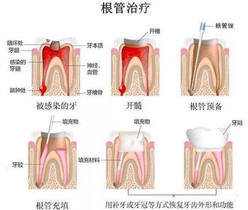 根管治疗过程