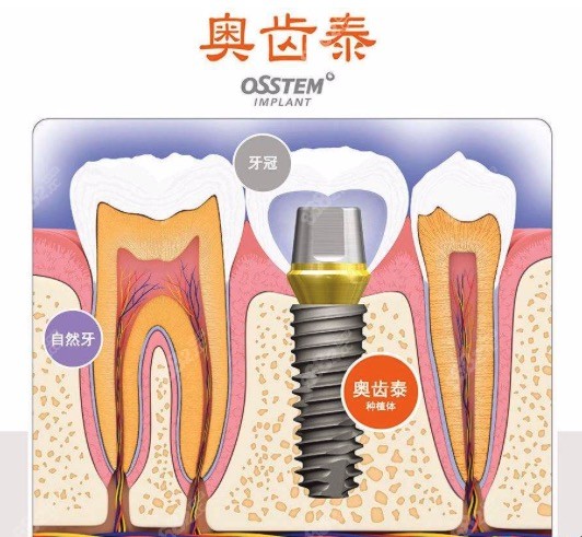 韩国奥齿泰种植体