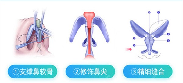 广州曙光蒋思军做鼻子好吗？