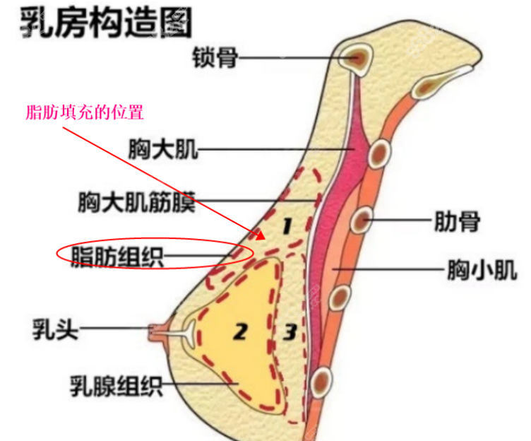 孙泽芳医生做自体脂肪丰胸填充的位置