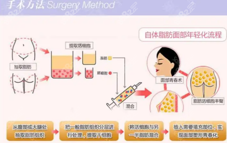 王自谦医生做面部自体脂肪填充