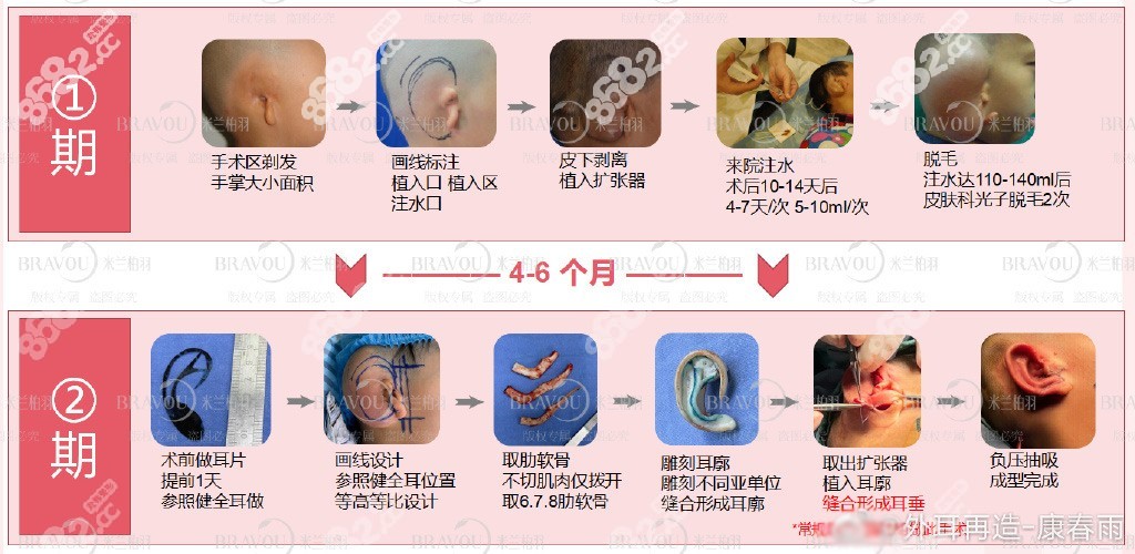 米兰柏羽康春雨医生做耳再造实例反馈