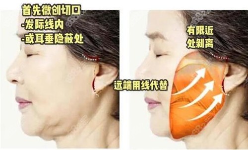 <!--<i data=20240705-sp></i>-->面中西部拉皮位置