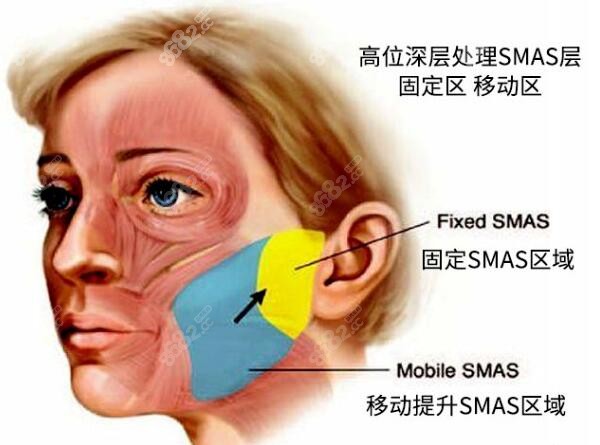 高位SMAS除皱术的区域