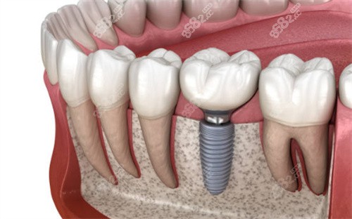 种植牙示意图