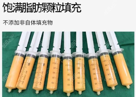 王自谦做面部脂肪填充抽取的脂肪