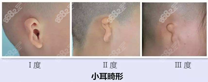 耳再造可以改善的耳朵畸形