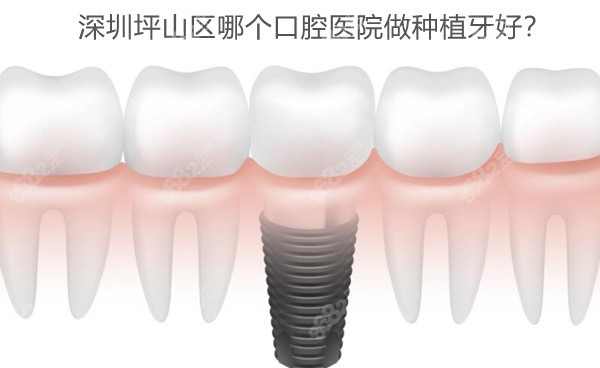 深圳坪山区哪个口腔医院做种植牙好