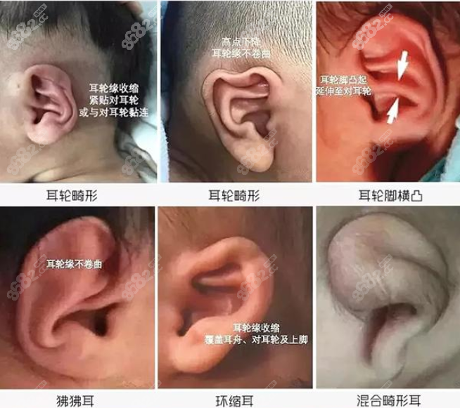 耳朵畸形种类