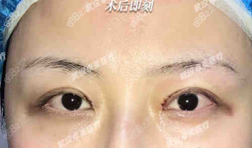 武汉卓美王海平院长修复双眼皮病例