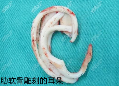 安波肋软骨支架材料
