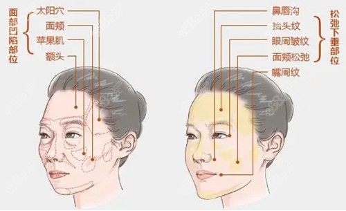 王自谦院长做自体脂肪后变年轻了