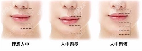 上海悦目佳容医疗美容门诊部人中缩短对比图