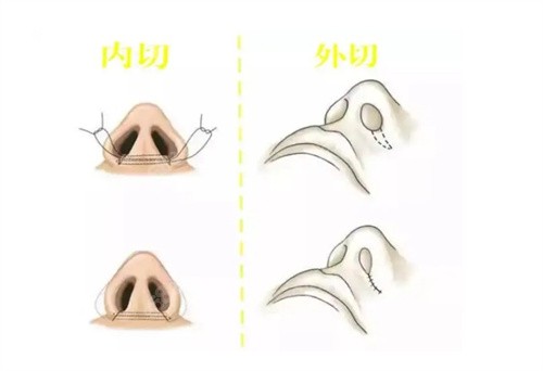 鼻翼缩小手术示意图