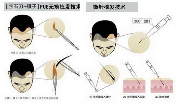 发际线采用微针比fue的区别