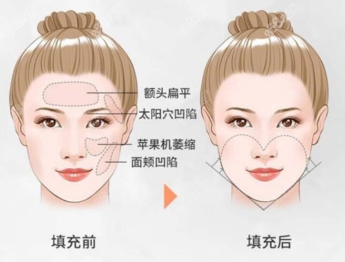 面部脂肪填充前后对比照片