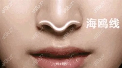 鼻部海鸥线示意图