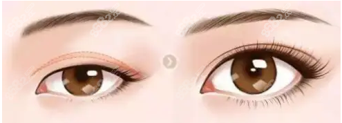 <!--<i data=20240705-sp></i>-->雙眼皮修復(fù)
