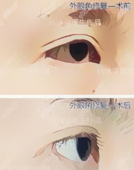 北京张冰洁外眼角修复真人前后对比照