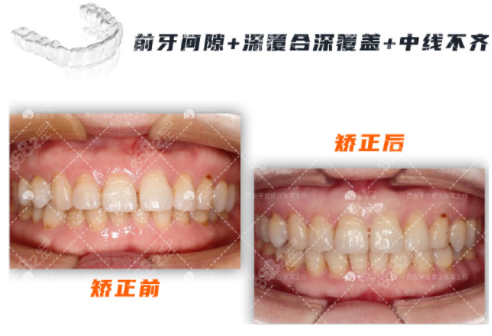 <!--<i data=20240705-sp></i>-->口腔张军牙齿矫正对比图