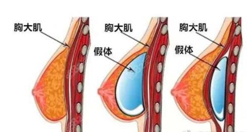 双平面隆胸的假体植入位置