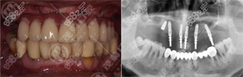 口腔种植牙病例 口腔种植牙病例