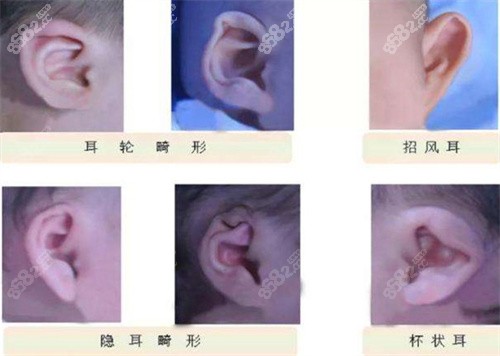 耳朵畸形常见种类照片