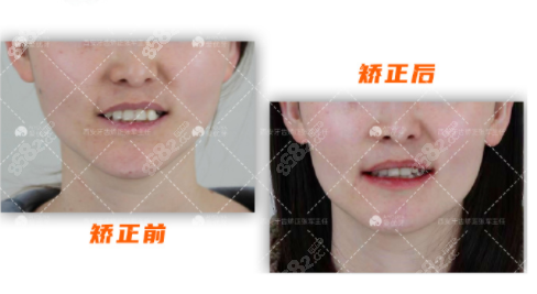 西安牙齿矫正对比图