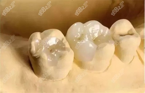 牙齿修复图