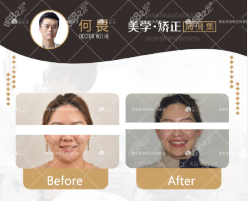 西安鼎秀齿科何畏牙齿矫正对比图