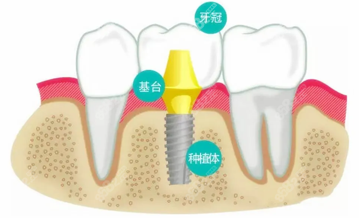 种植牙种植流程