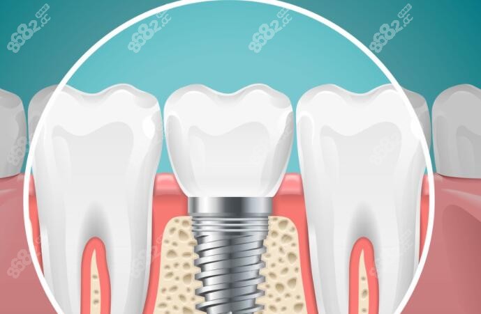 杭州种植牙国 家补贴5000元 杭州种植牙国 家补贴5000元