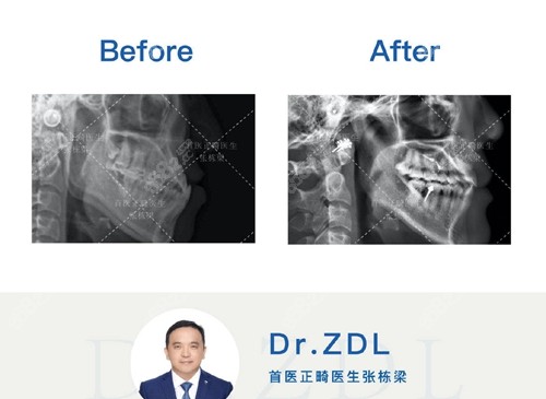 禾禾齿科张栋梁医生做牙齿矫正对比实例图