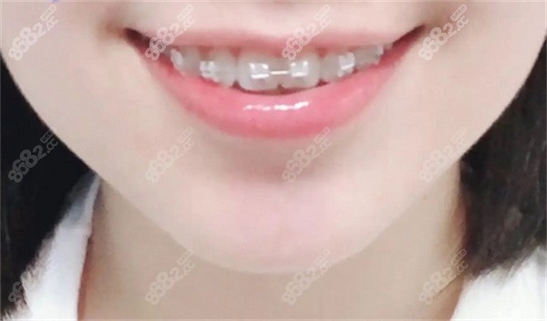 厦门牙齿矫正价格表