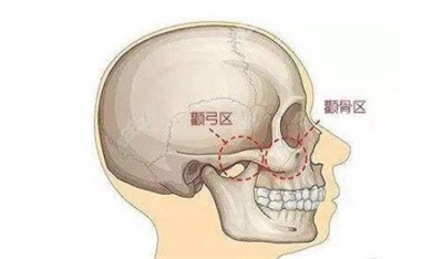 赵延峰医生颧骨内推的技术优势
