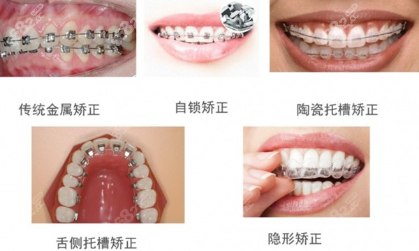 厦门隐形牙套价格