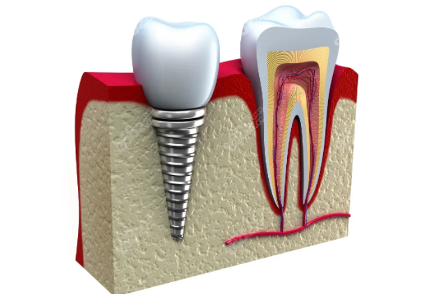 淮安微创技术种植牙的费用比常规的要几千元