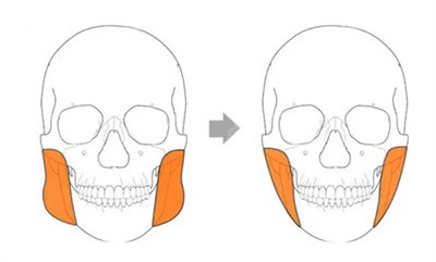 <!--<i data=20240705-sp></i>-->医生在颧骨颧弓整形方面的技术优势1
