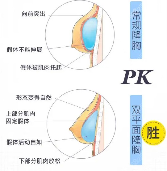 罗盛康双平面隆胸技术优势