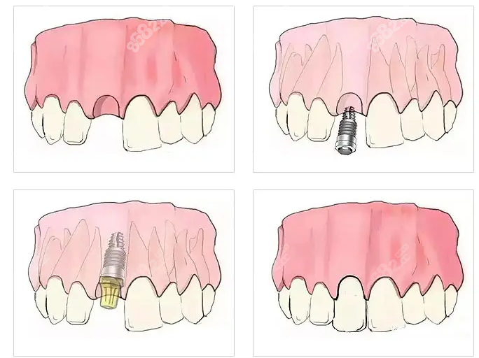 即刻种植牙过程
