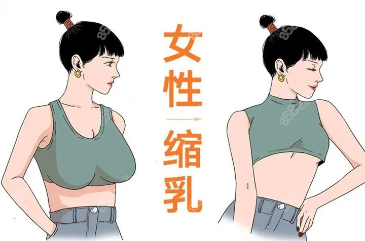 乳房缩小手术对比