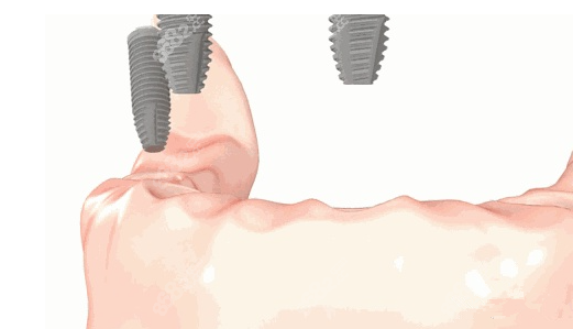 如果种植手术不熟练，可能会伤及相邻牙齿或下槽神经
