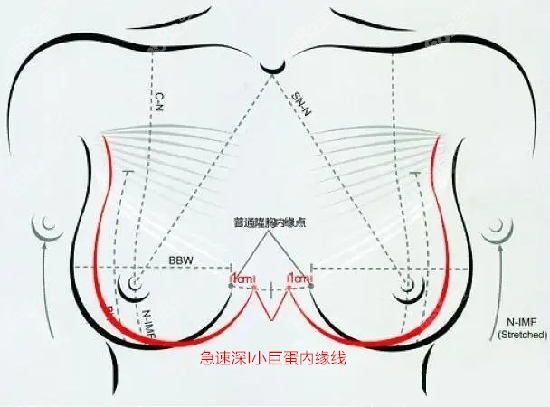 艾建英医生急速深I小巨蛋隆胸美学