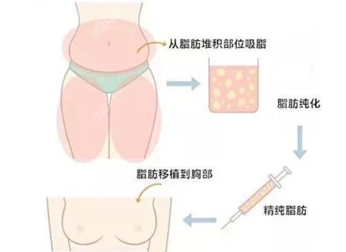 北京禾美嘉贺天遥做自体脂肪隆胸示意图