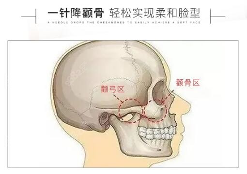 一阵将颧骨靠谱吗